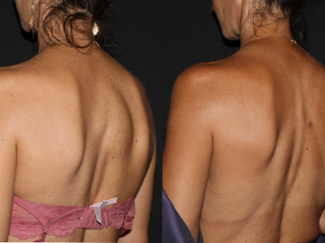 Minimal Scar Lipoma Removal case #43037