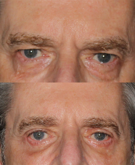 Blepharoplasty case #43315