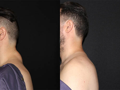 Minimal Scar Lipoma Removal case #43262