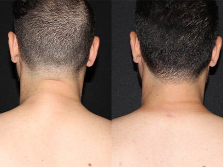 Minimal Scar Lipoma Removal case #43262