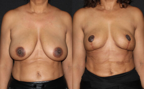Breast Reduction case #43395